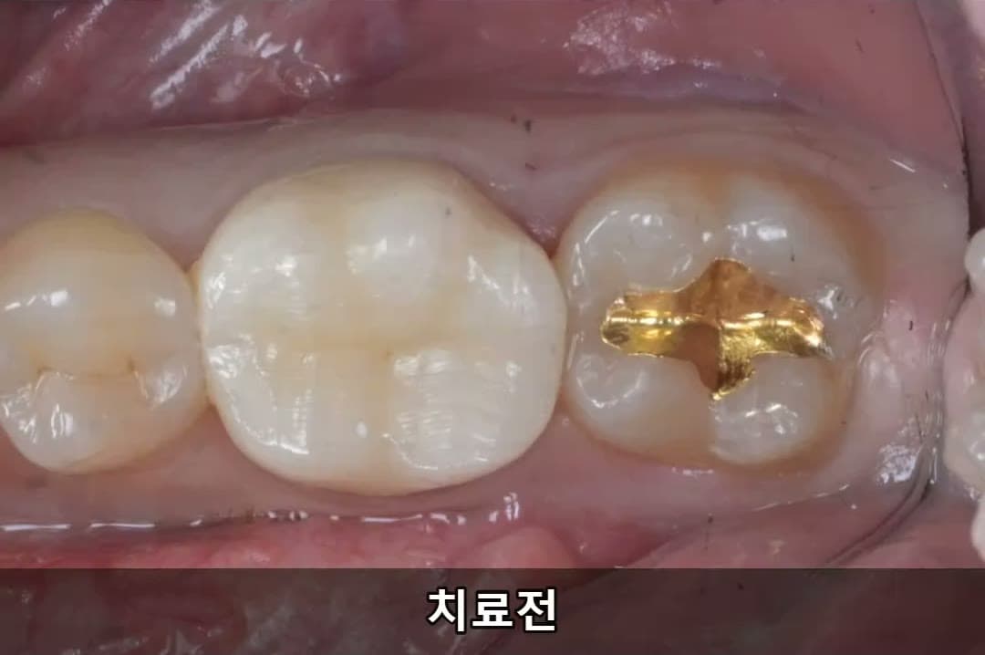 #37 레진빌드업 - 신영통튼튼이치과 - 레진빌드업 썸네일
