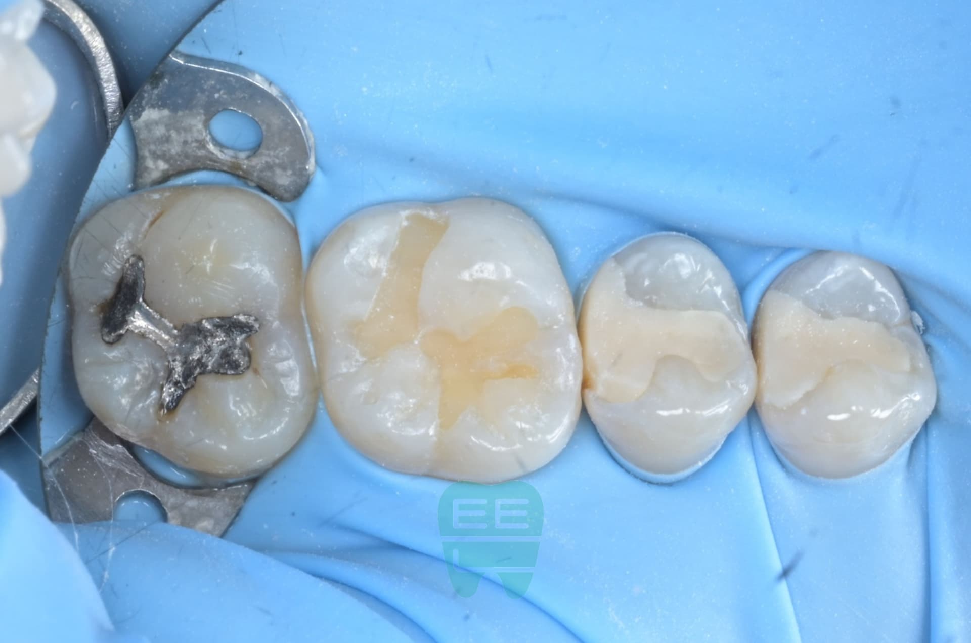 최소침습 레진빌드업을 통한 minimal invasive dentistry - 레진빌드업 썸네일