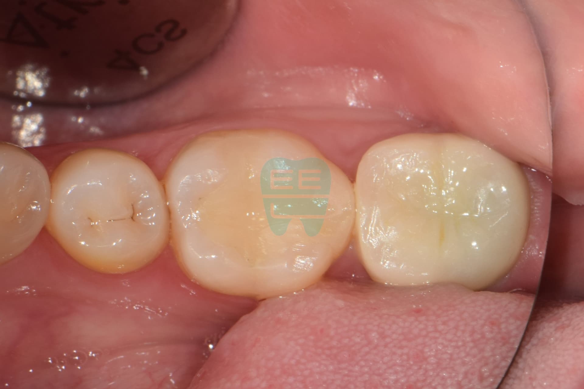 보철에서 냄새가 나요.. 재근관치료를 위한 wall쌓기 치료 증례 - 미세현미경 근관치료 썸네일