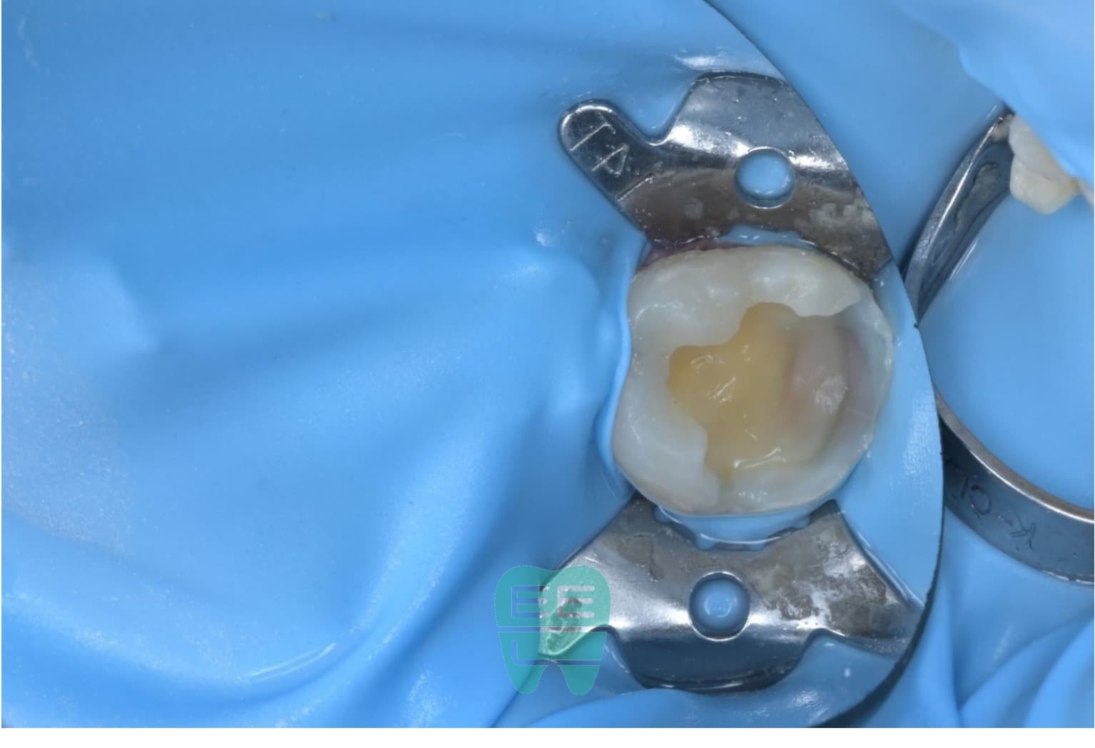 소아/청소년 충치치료는 최소침습 레진 빌드업이 정답 — 만 9세 #46 광범위 2차우식 치료 증례 - 레진빌드업 썸네일