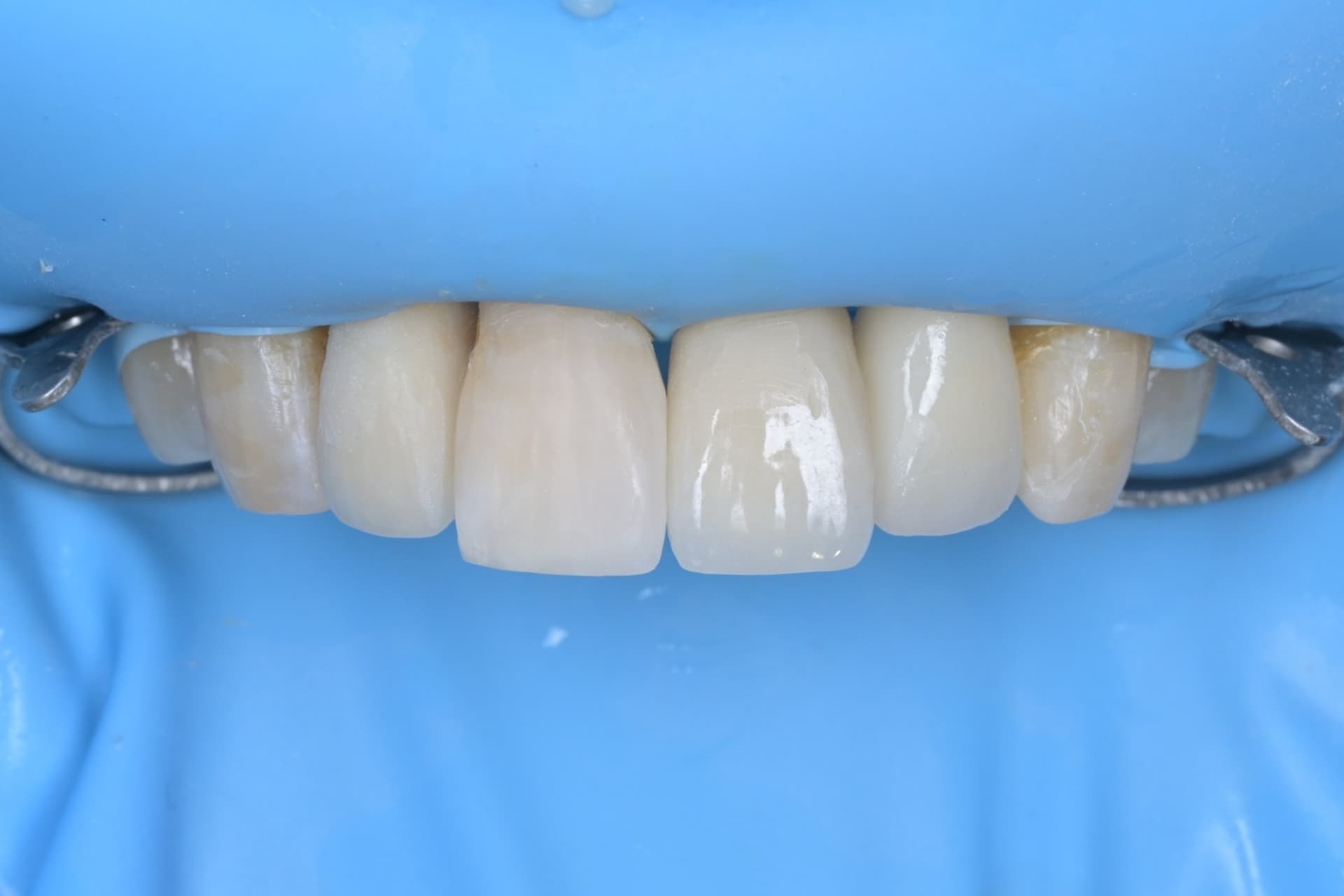 망포역 충치치료 잘하는 치과? 러버댐을 거는지 확인하세요 - 레진빌드업 썸네일